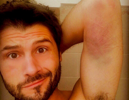 Aïe le bobo ! Christophe Beaugrand partage la photo de son vilain bleu sur Twitter après sa mauvaise chute (Photos)