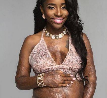 Une femme enceinte prend en photo son ventre avec des cicatrices de brûlures
