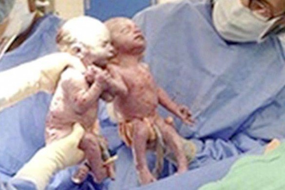 Deux ans après leur naissance, ces jumelles se tiennent toujours la main !